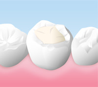 レジンの詰め物(レジン充填)